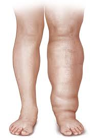 linfedema2