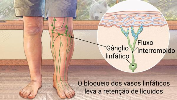 linfedema3