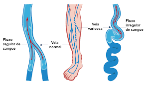 varizes2