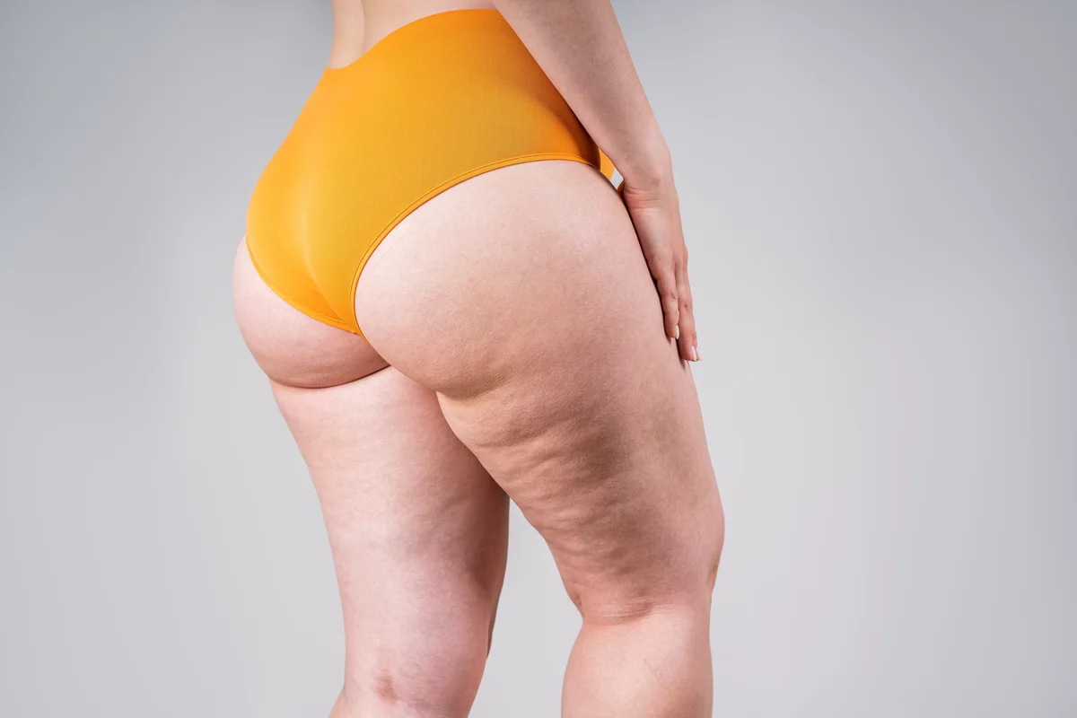 Lipedema